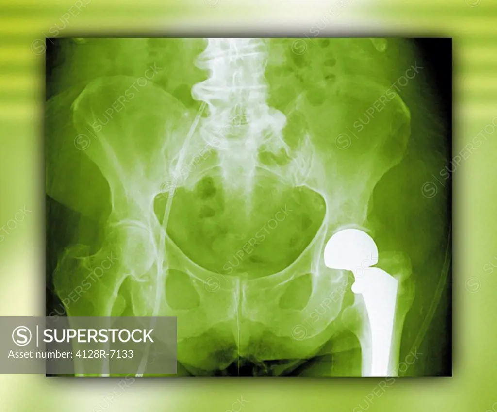Total hip replacement, X_ray