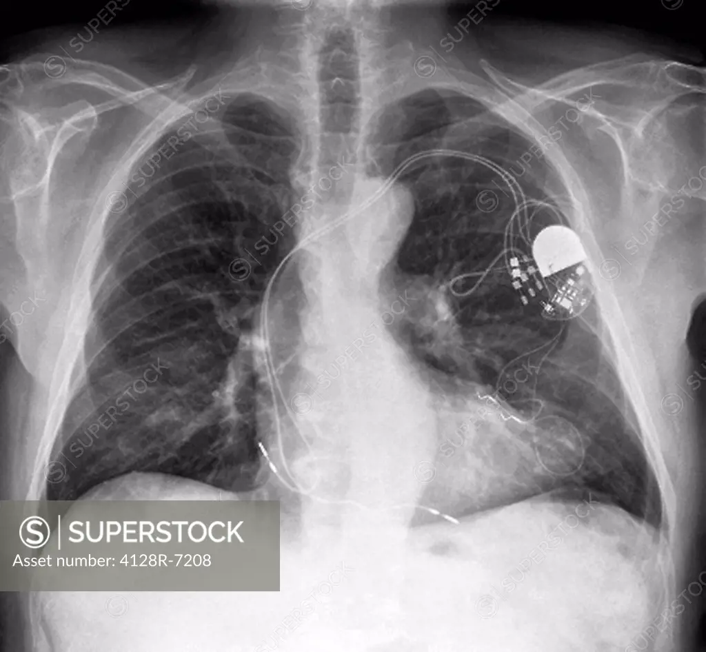 Heart pacemaker, X_ray