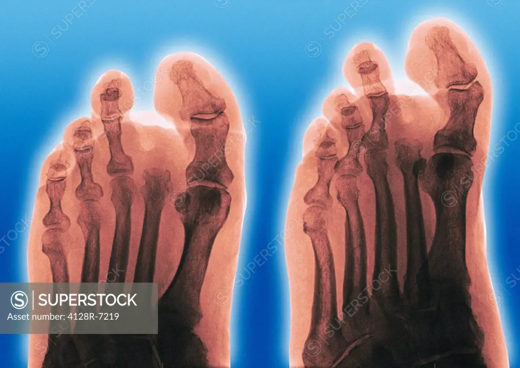Amputated toe, X_ray