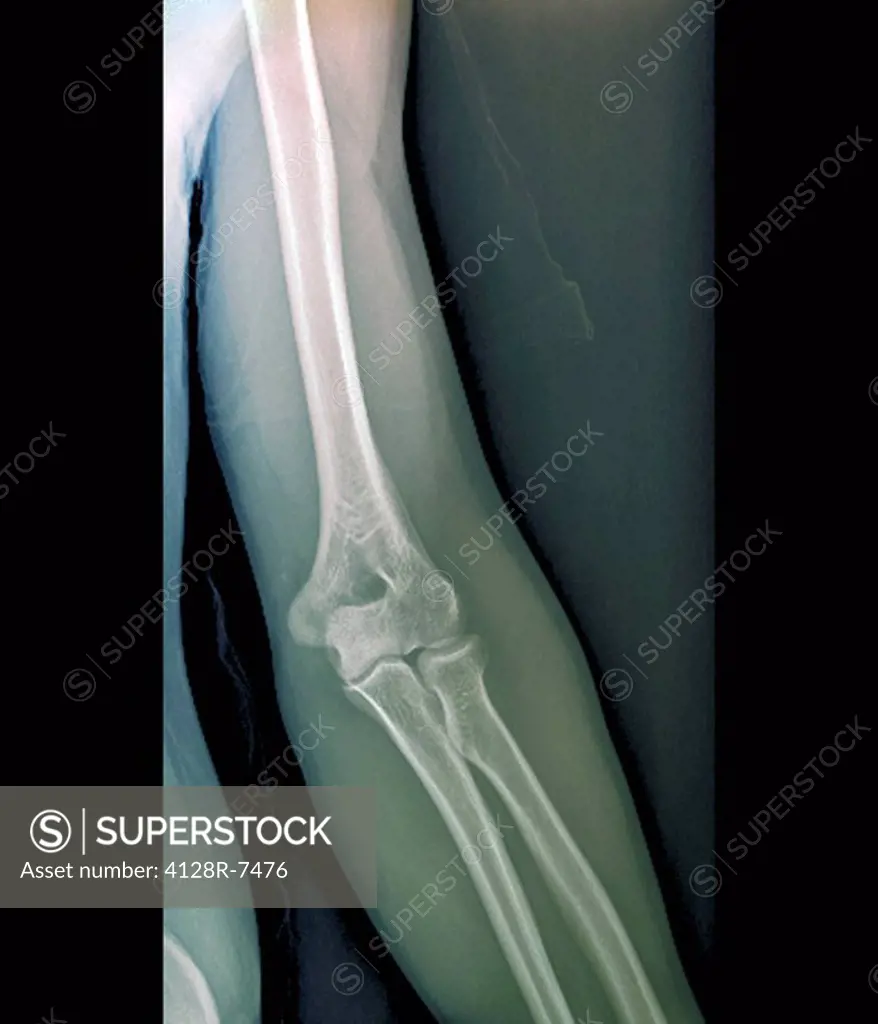Normal elbow joint, X_ray