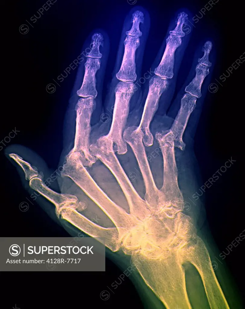 Arthritic hand, X_ray