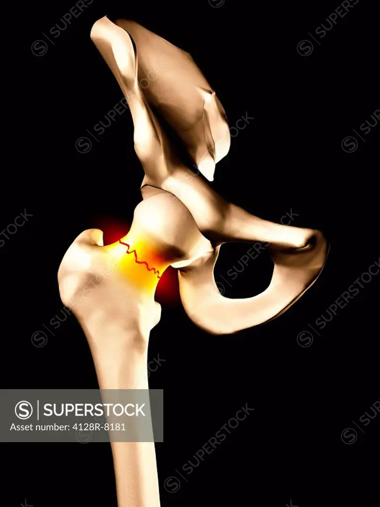 Fractured hip bone, artwork