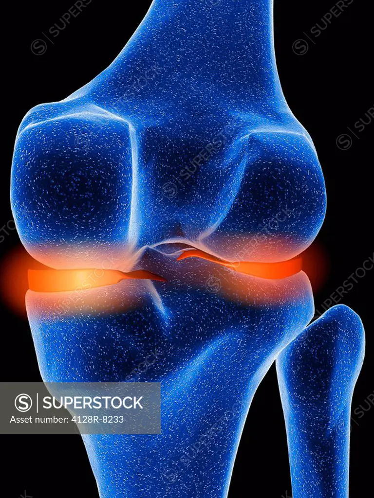 Inflamed knee cartilage, computer artwork