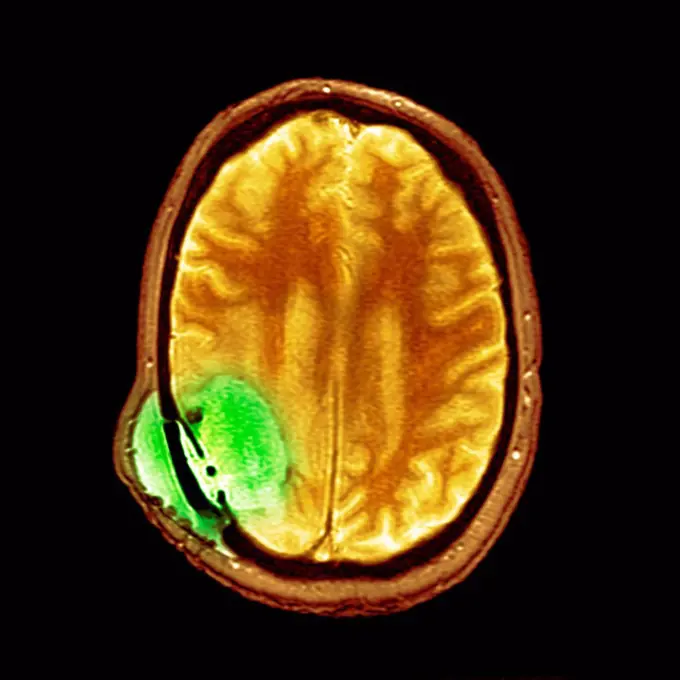 Brain cancer after surgery, MRI scan
