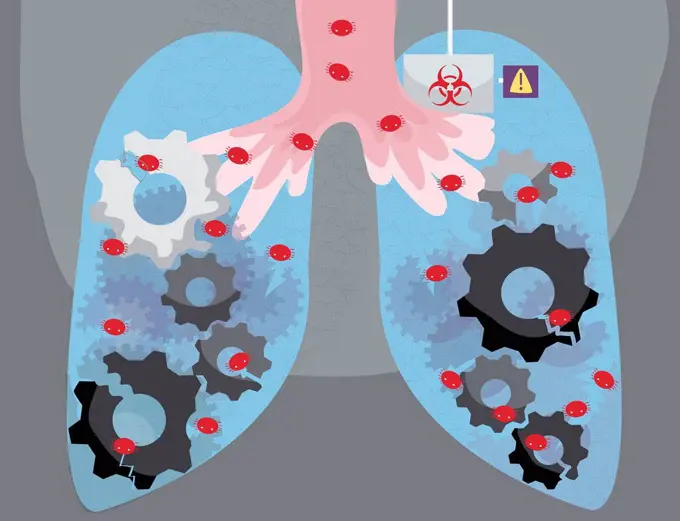 Illustration of human lungs infected by virus