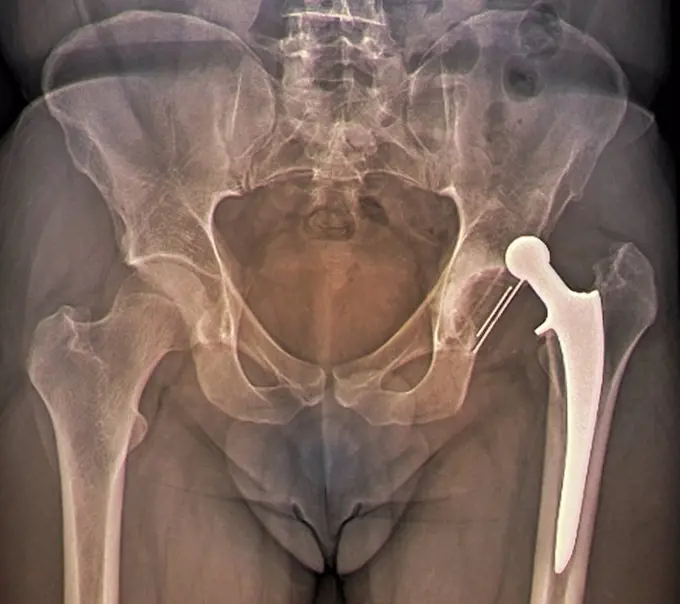 Dislocated hip replacement. Coloured frontal X-ray of the pelvis of a 35 year old patient with an artificial left hip (right) that has become dislocat...