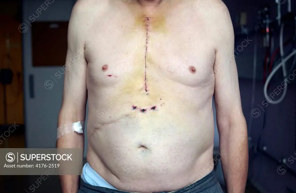 Scars after a chest surgery