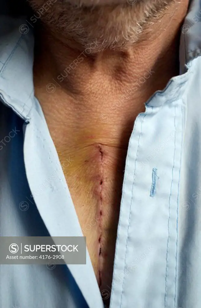 A man with a scar on his chest after an operation