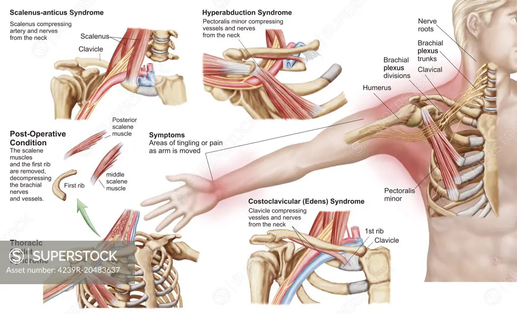 Medical illustration detailing thoracic outlet syndrome. - SuperStock
