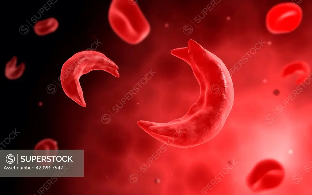 Microscopic view of sicke cells causing anemia disease.