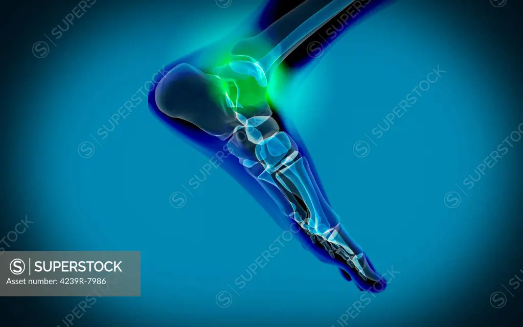 X-ray view of pain in human foot.