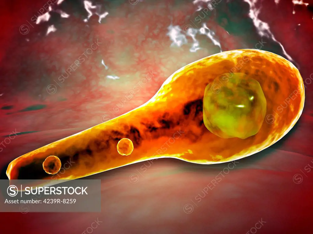 Microscopic view of Tetanus. Tetanus is caused by the tetanus bacterium, Clostridium tetani. Tetanus is often associated with rust.