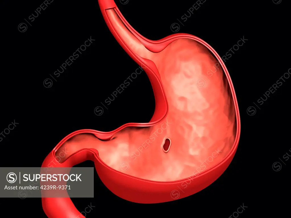 Conceptual image of peptic ulcer in human stomach.