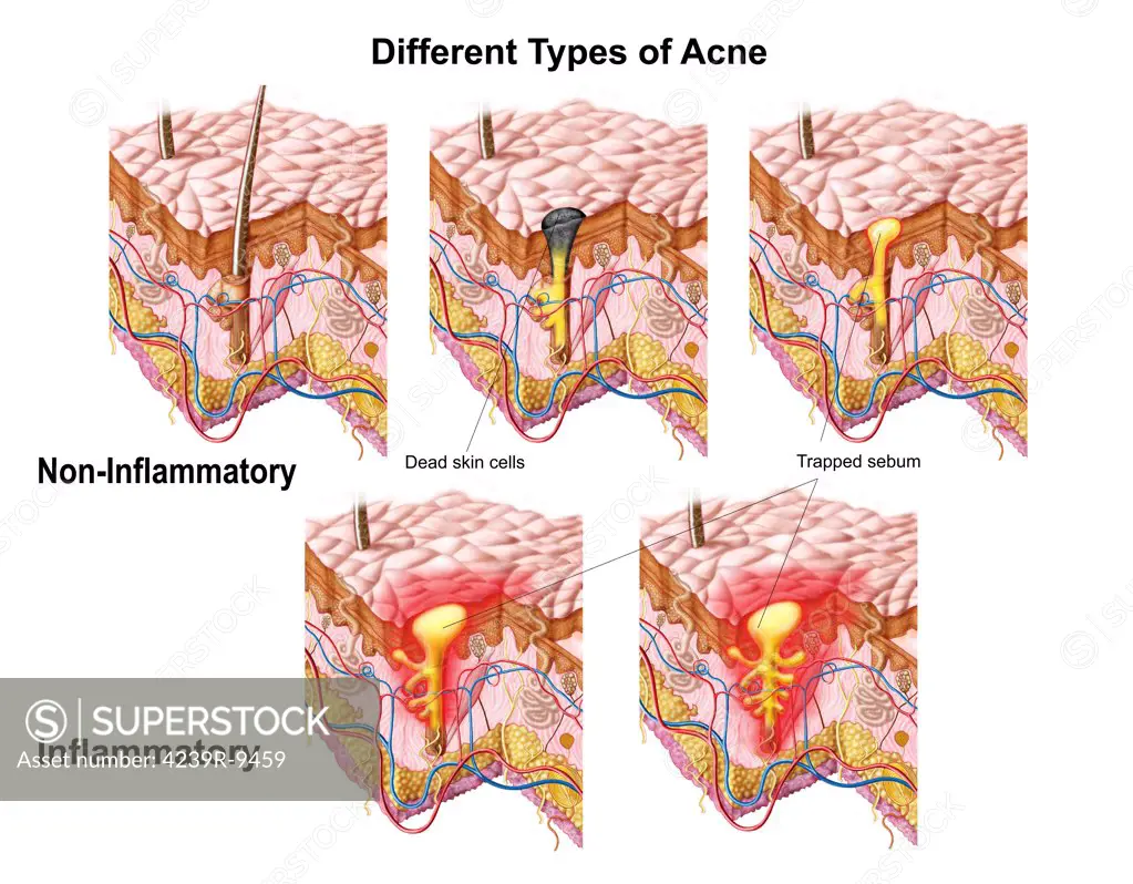 Different types of acne, non-inflammatory and inflammatory.