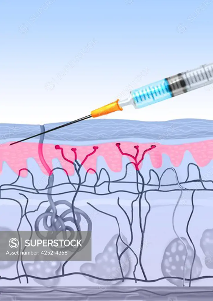 A dermis injection is for vaccinations