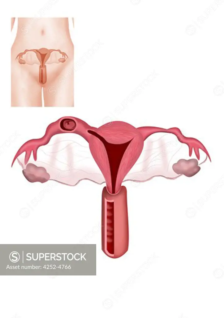 Tubal pregnancy
