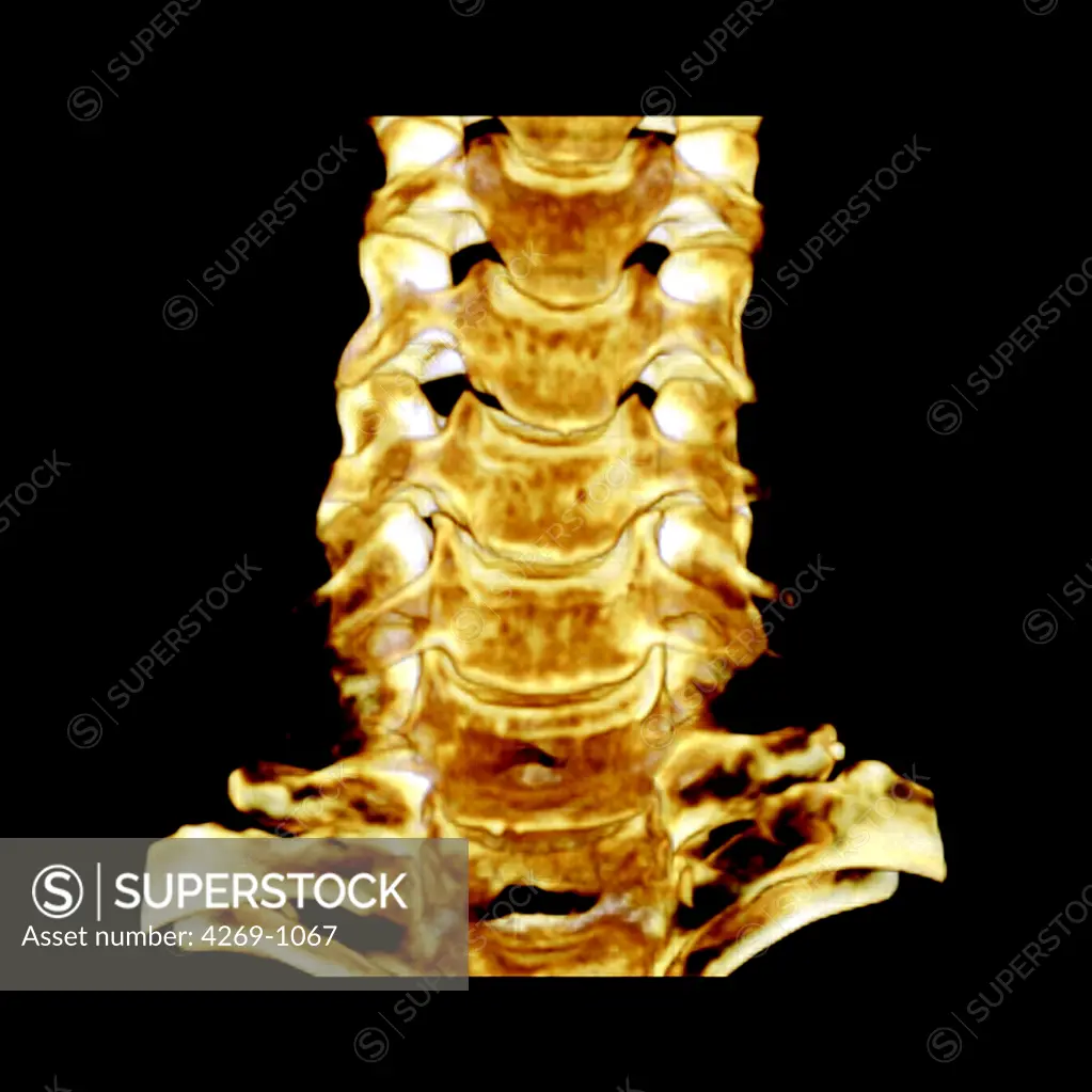 Three-dimensional computed tomographic (CT) scan reconstruction of cervical rachis, composed of 7 cervical vertebras.