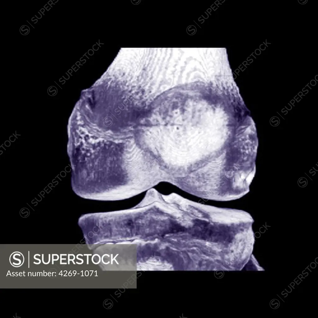 Three-dimensional computed tomographic reconstruction of the knee, formed by the articulation of the femur (thigh bone, top) with the tibia (shin bone, below). The kneecap (patella) is the round shape that lies over the lower part of the femur.