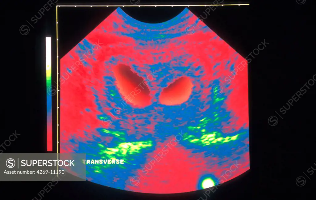 Foetal ultrasound scan showing twin pregnancy.