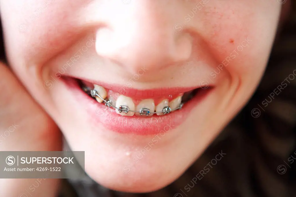 Teenager with fixed braces on her teeth.