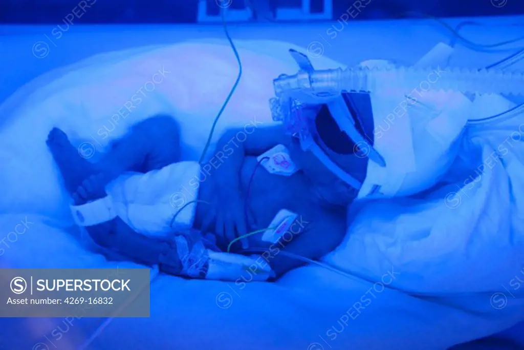 Newborn baby undergoing ultraviolet light treatment for jaundice. Neonatalogy department, Robert Debré hospital, Paris, France.