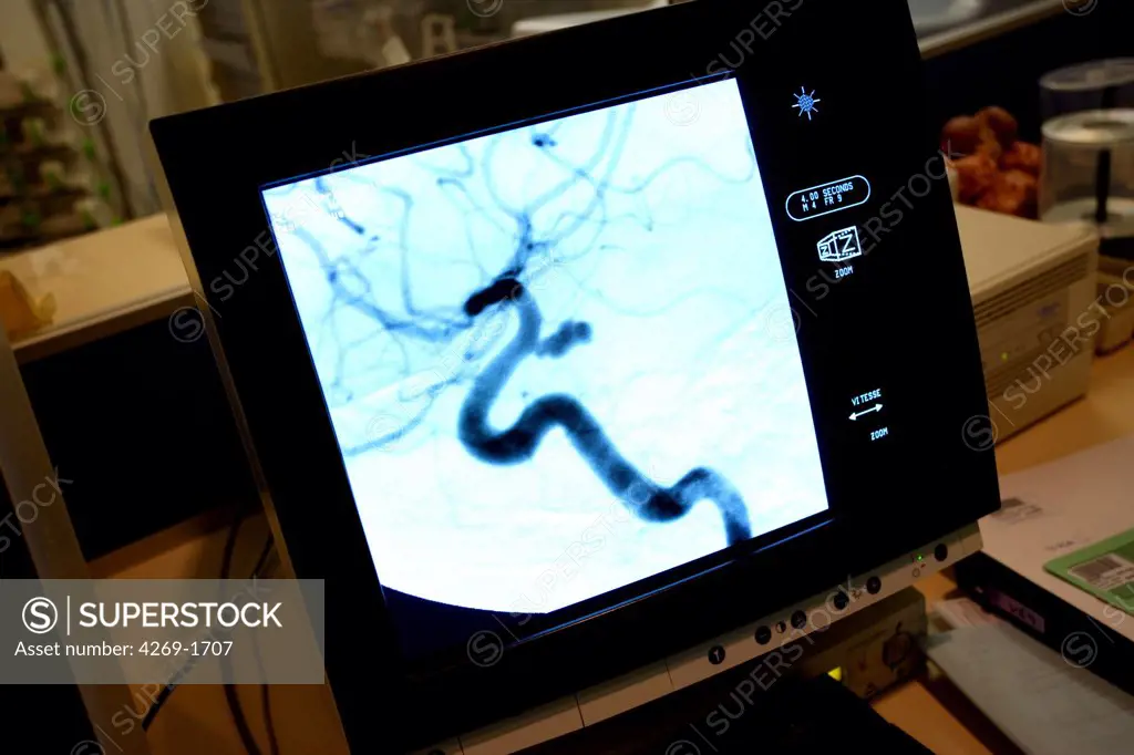 Unit of Laënnec Hospital of Nantes, France, specialized in Cerebrovascular Accidents (CVA). Monitoring control screen of the cerebral angiography (arteriography) showing an aneurysm of the basilar artery.