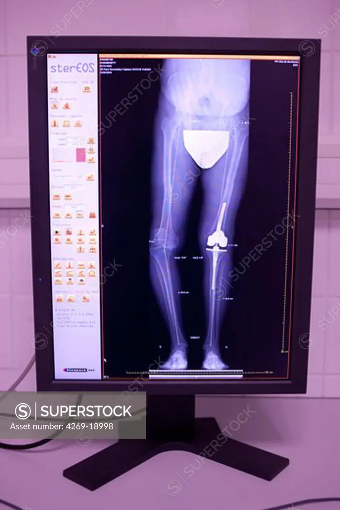 This 2D and 3D digital X-ray imaging equipment is dedicated to the orthopedic practice and permits a static study of the musculoskeletal system. It takes by low dose X-ray scanning two simultaneous, perpendicular planar views in the standing position. A reconstruction provides a 2 and 3D image of the osteoarticular structures of the patient. The university hospital of Bordeaux is the first hospital to use this diagnostic technique in France.