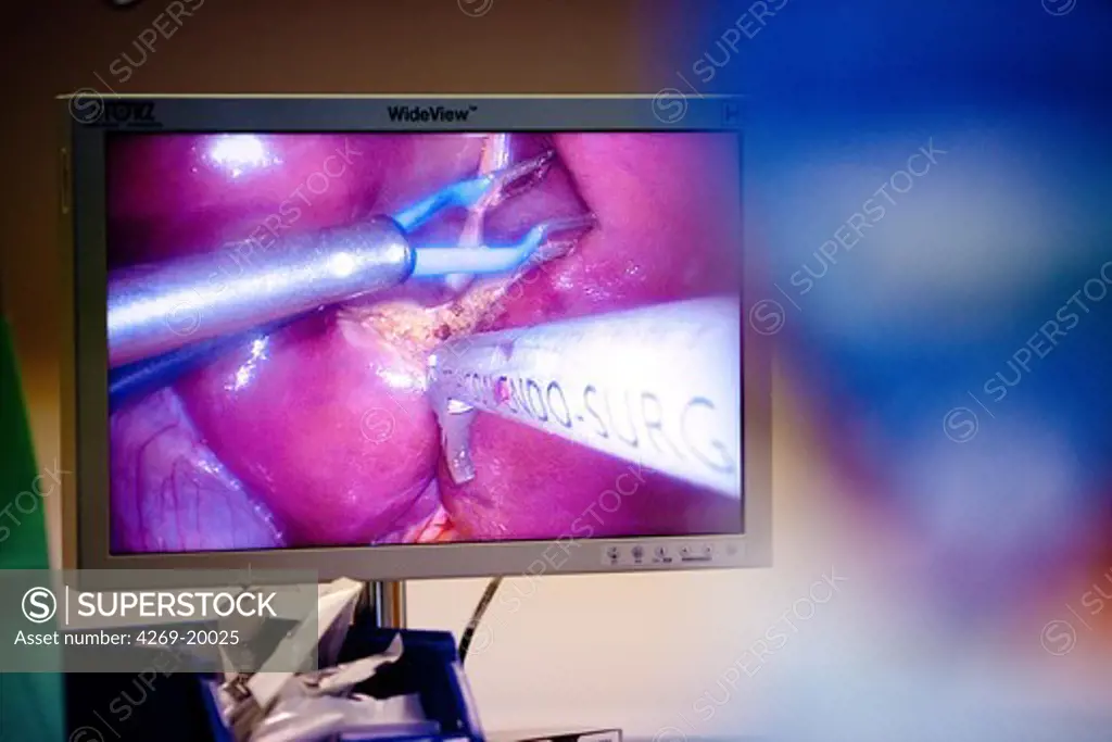 Partial removal of a liver from a living donor by laparoscopy for a transplantation. Department of Surgery of Pr Olivier Soubrane. St Antoine hospital, Paris.