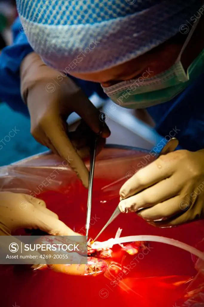 Partial removal of a liver from a living donor by laparoscopy for a transplantation. Here, graft preparation. Department of Surgery of Pr Olivier Soubrane. St Antoine hospital, Paris.