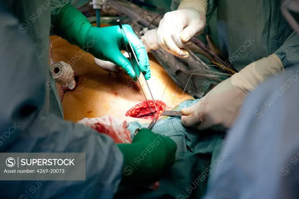 Partial removal of a liver from a living donor by laparoscopy for a transplantation. Here, stitches a the end of surgery. Department of Surgery of Pr Olivier Soubrane. St Antoine hospital, Paris.
