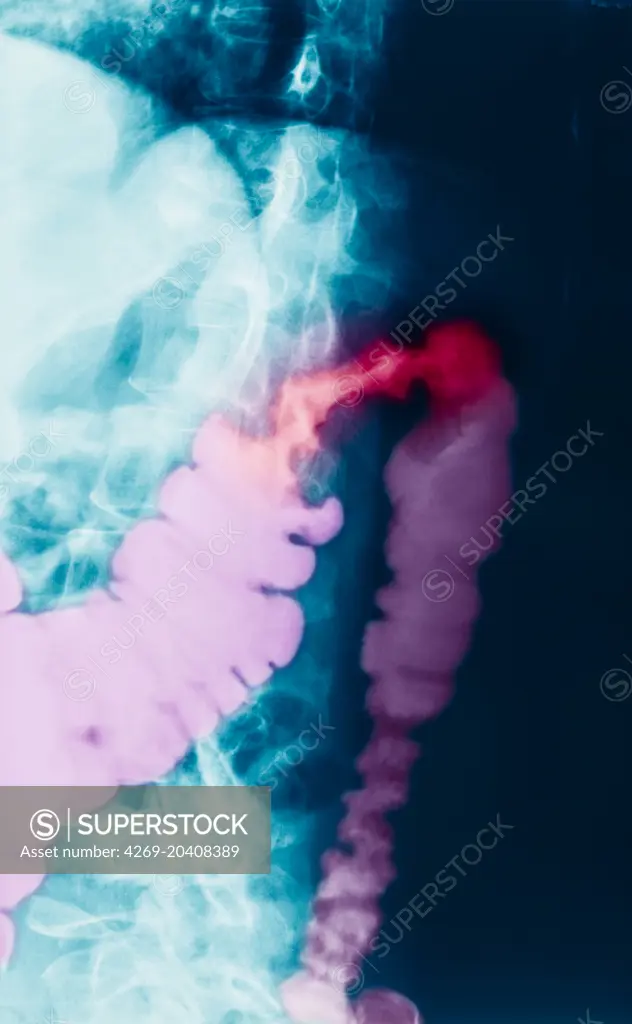 Color enhanced x-ray of a patient with colon cancer.