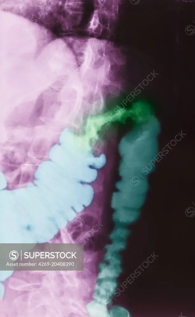 Color enhanced x-ray of a patient with colon cancer.