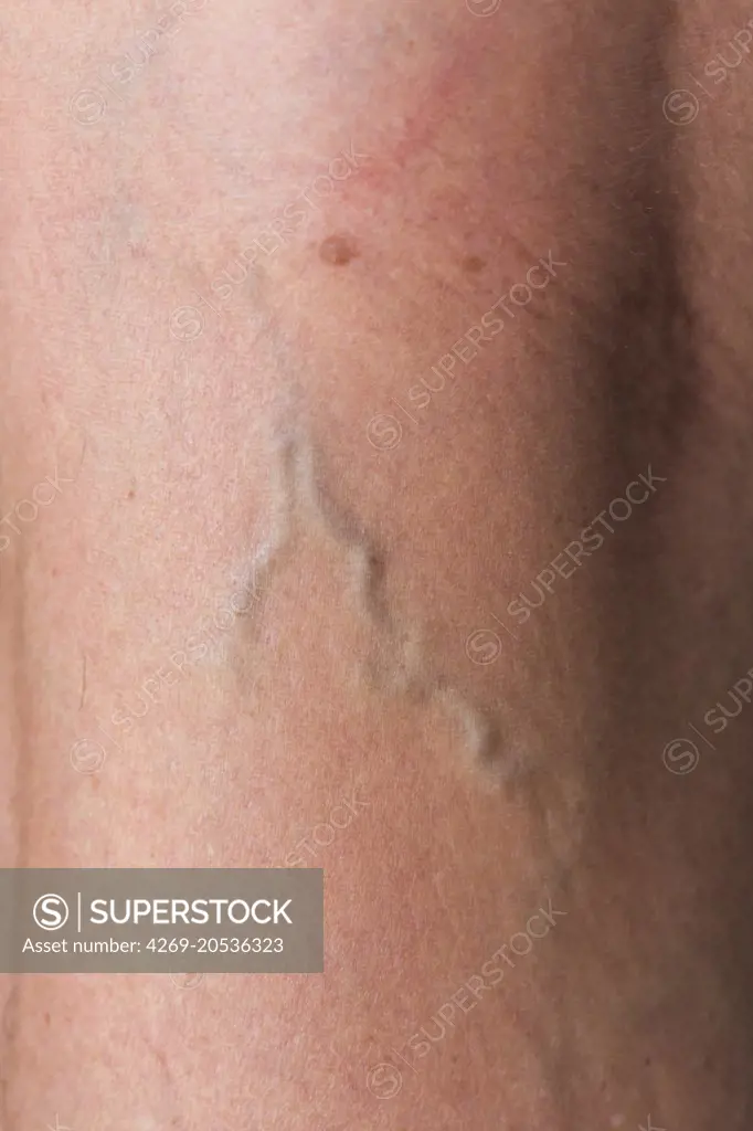 Varicose vein in the leg.
