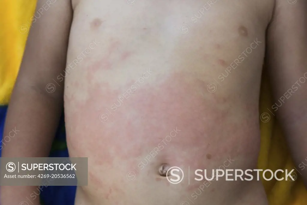 Rash from allergy on the torse of a 2 year old baby.
