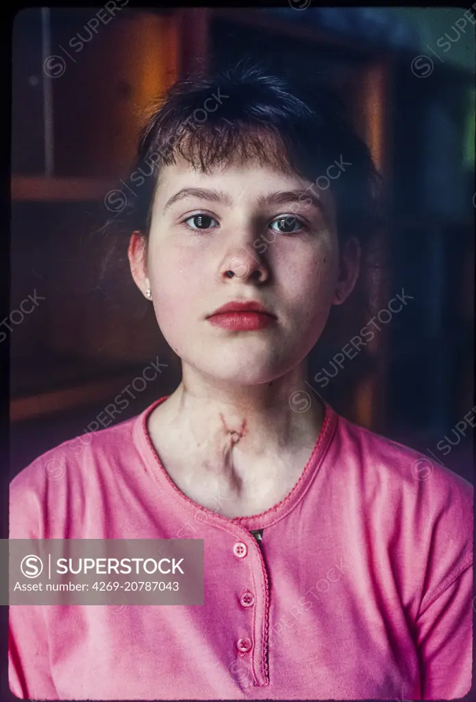 Medical center of Kiev child with thyroid cancer after the Chernobyl nuclear accident, operated by incompetent doctors and taken over by the association "Children of Chernobyl", Ukraine, May 1995.