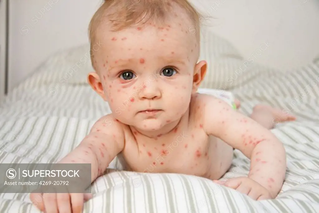 Chickenpox on a 4 months old baby.