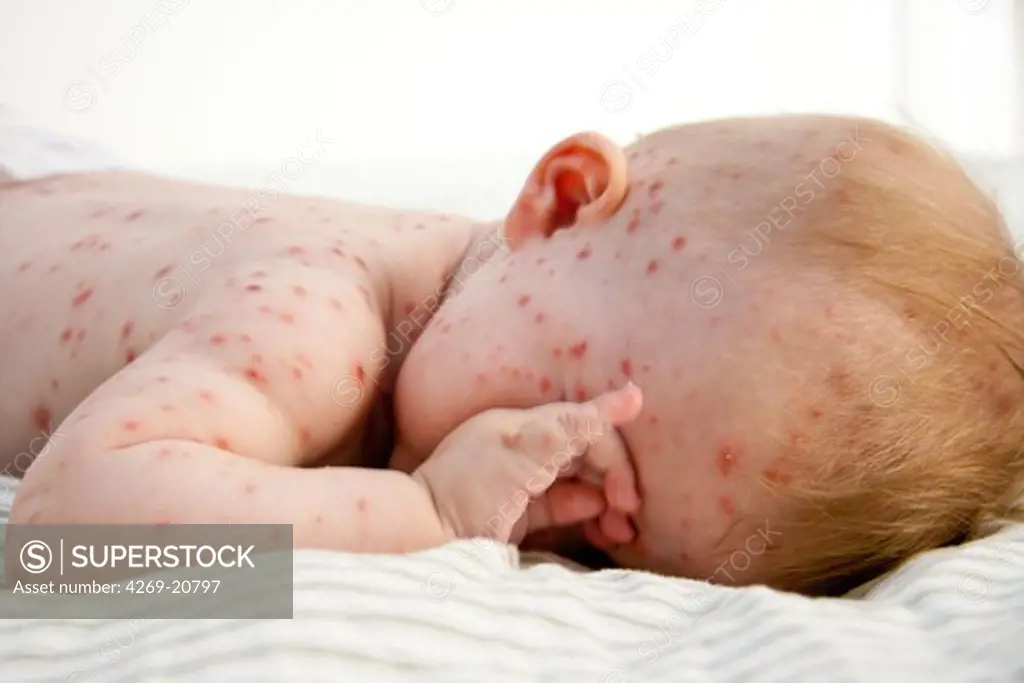 Chickenpox on a 4 months old baby.