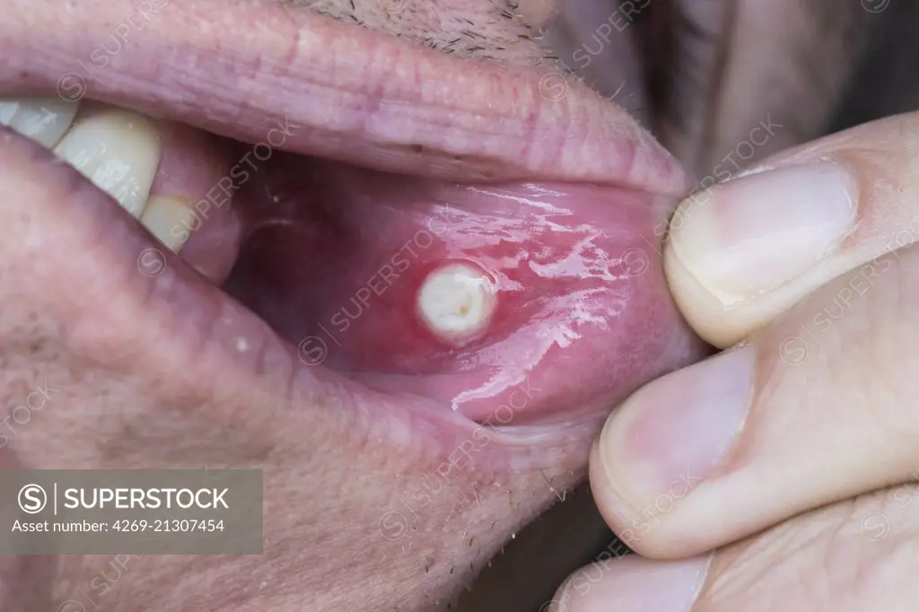 Close-up of an aphthous ulcer in the mouth of a man.