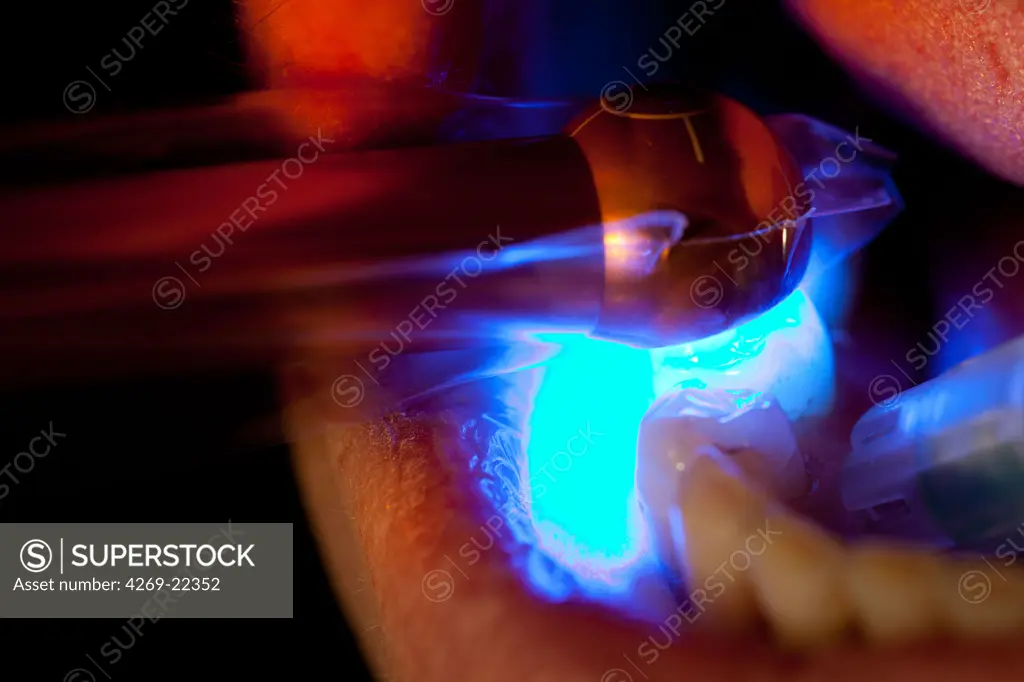 Dentist using ultraviolet light to set a photosensitive amalgam (filling).