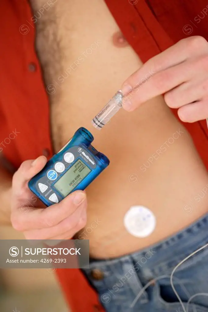 The programmable insuline pump releases small amounts of insulin at a time via a subcutaneous catheter, allowing the user to control exactly how much insulin is delivered. This is an alternative method to insulin injection.