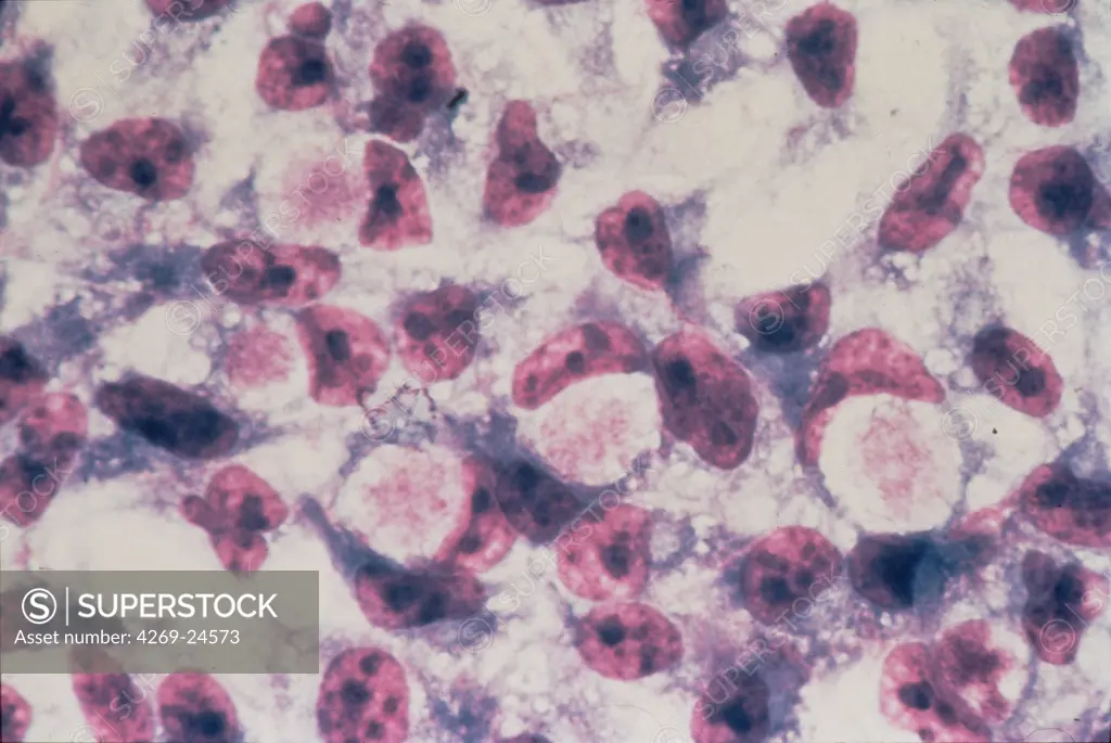 Chlamydia trachomatis. Light microscopy of cervical smear showing epithelial cells infected with the bacterium Chlamydia trachomatis, responsbile for genital and eye infections.