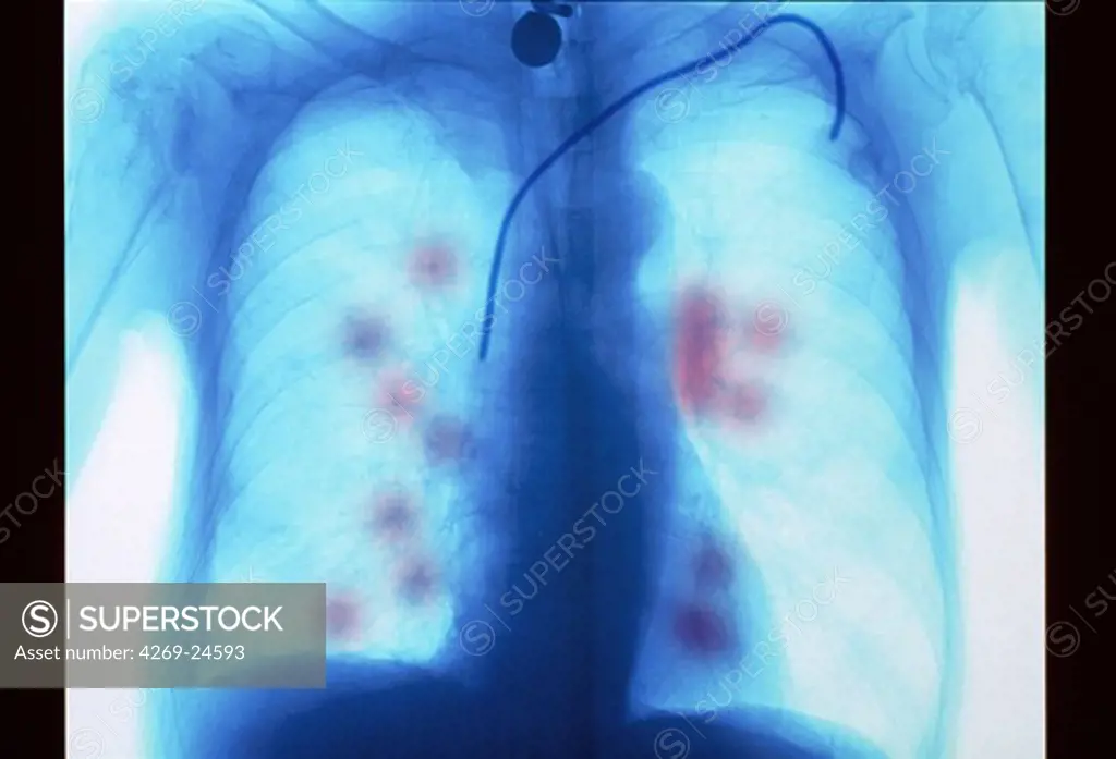 Lung cancer. Lung cancer and metastasis (red) Catheter of chemotherapy X-ray