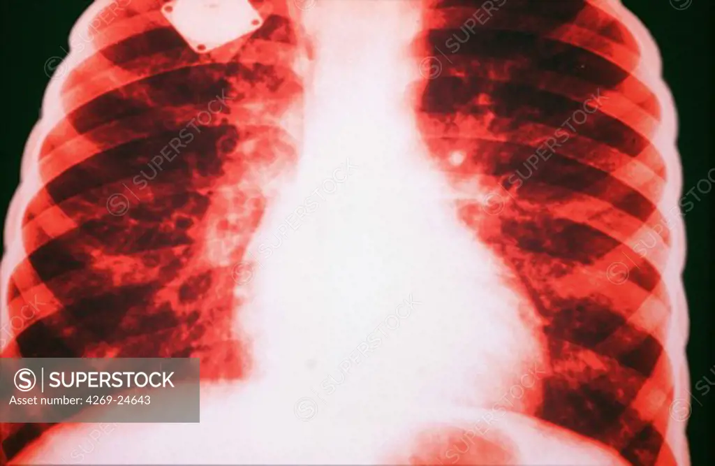 Mucoviscidosis. Color enhanced chest x-ray showing mucoviscidosis (cystic fibrosis), a hereditary disease that causes certain glands of the body to produce abnormal secretions. The lungs are affected by this, causing a tendency to chronic lung infections.
