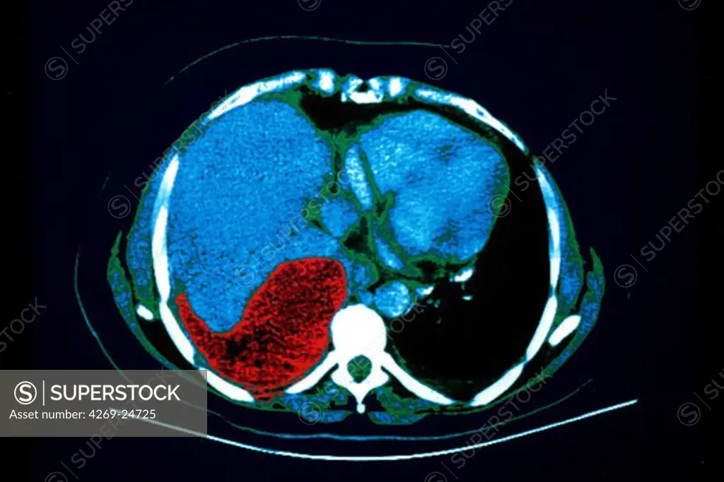 Pleural effusion and lung cancer. Axial computed tomography (CT) scan of the abdomen showing a large lung tumor (red) on the left, and a pleural effusion at right associated with a pleurisy. A pleural effusion is the accumulation of fluid  in the pleural cavity (black)