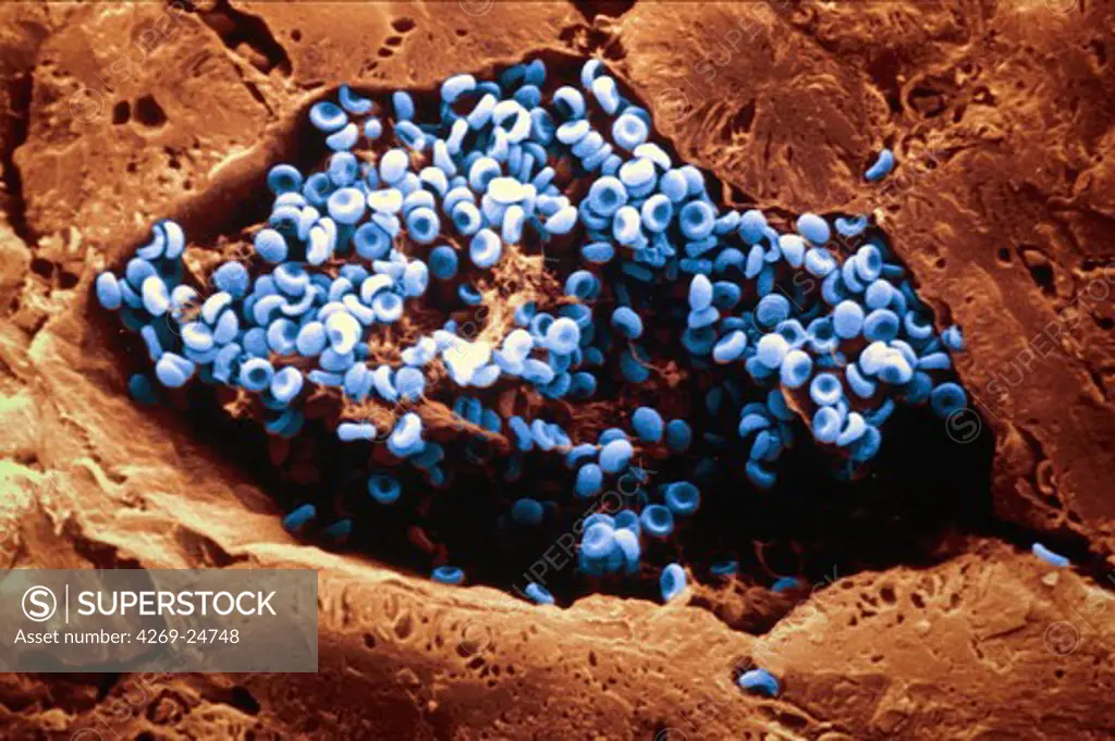 Sinusoid. Blood capillary between hepatic cells Red blood corpuscules (red corpuscles) and fibrine filaments SEM (Scanning Electron Microscope)