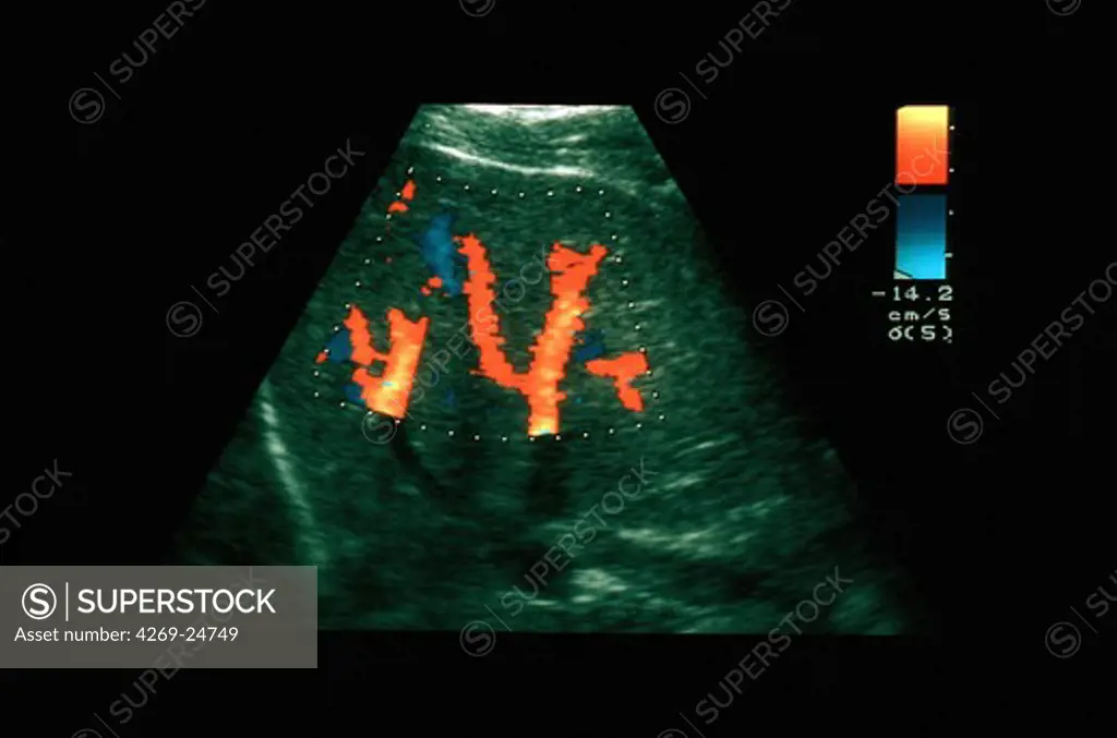 Doppler ultrasound scan of liver. Power Doppler ultrasound scan of blood flow in a normal liver. Doppler ultrasound scanning detects moving fluids, such as blood, by the frequency change they cause when reflecting high-frequency sound waves.