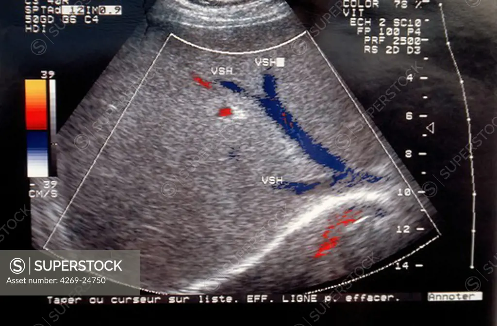 Power Doppler ultrasound scan of liver. Power Doppler ultrasound scan of blood flow in a normal liver. Doppler ultrasound scanning detects moving fluids, such as blood, by the frequency change they cause when reflecting high-frequency sound waves.