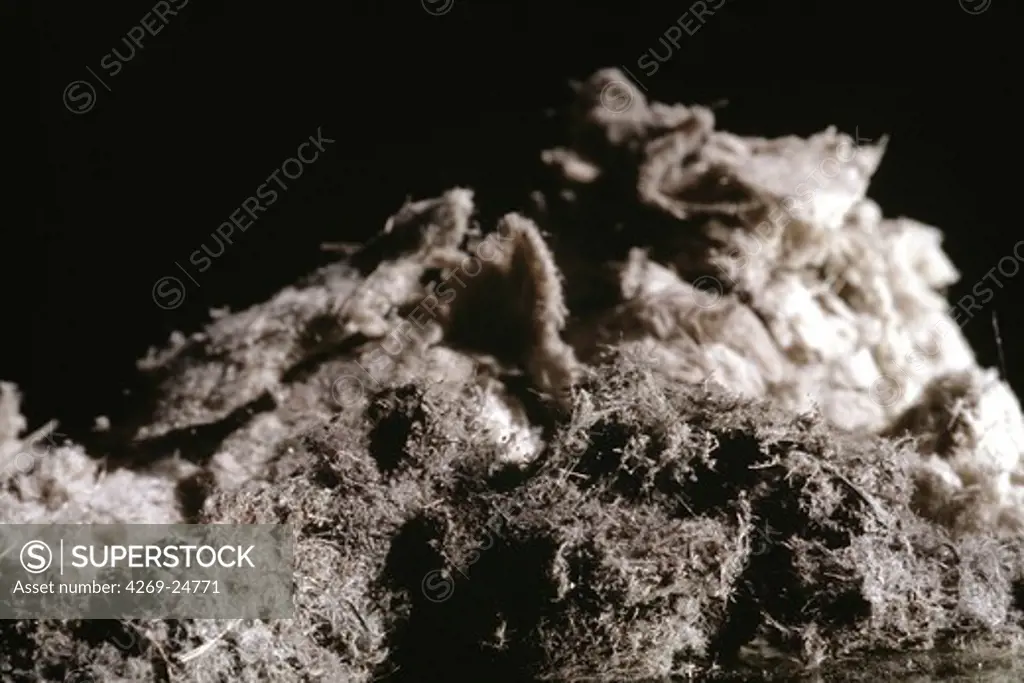 Asbestos. Asbestos fibres, responsible for lungs affections such as asbestosis