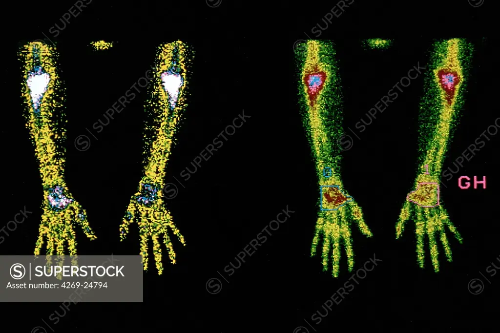 Rheumatoid polyarthritis. Scintigram of the arms showing rheumatoid polyarthritis in the elbows and wrists.
