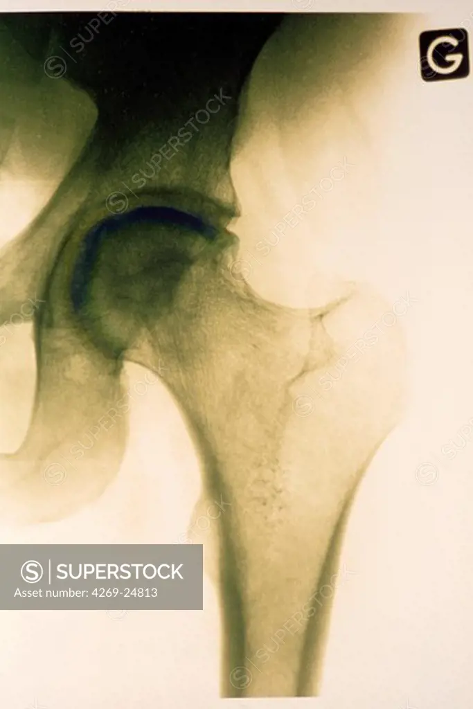 Hip. Femoral head osteonecrosis X-ray